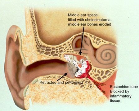 Ossiculoplasty Ear Surgery