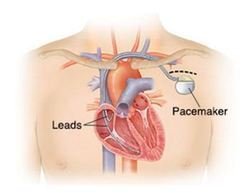 PPI-Permanent Pacemaker Implant – Single Chamber
