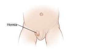 Pediatric Inguinal Hernia Repair