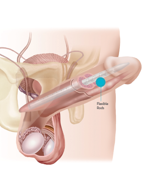 Penile Implantation – Single