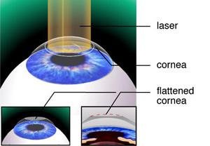 Photorefractive Keratectomy