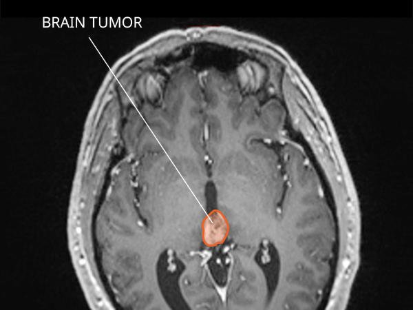 Pineal Region Tumors Treatment