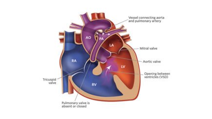 Pulmonary Atresia Surgery